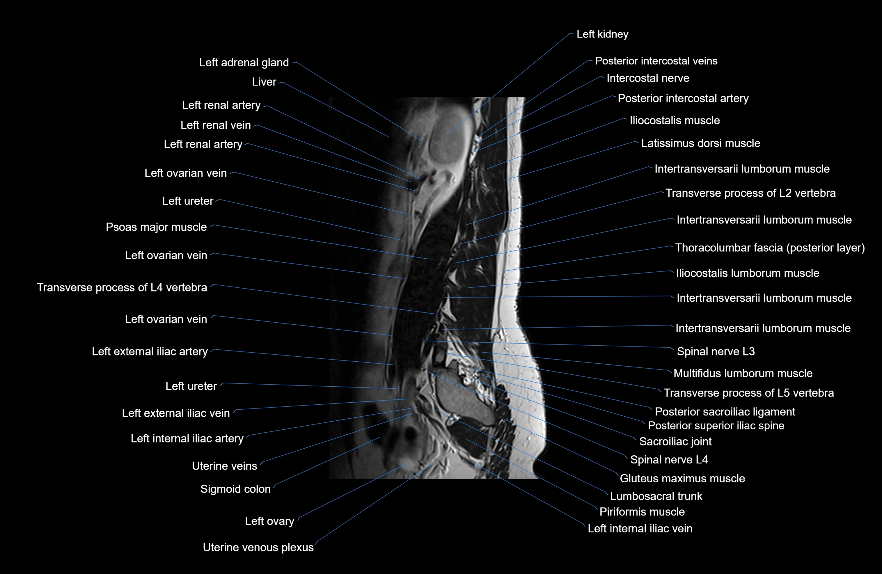 MRI lumbar spine sagittal cross sectional anatomy 3T radiology  image-img-00001-00026.webp